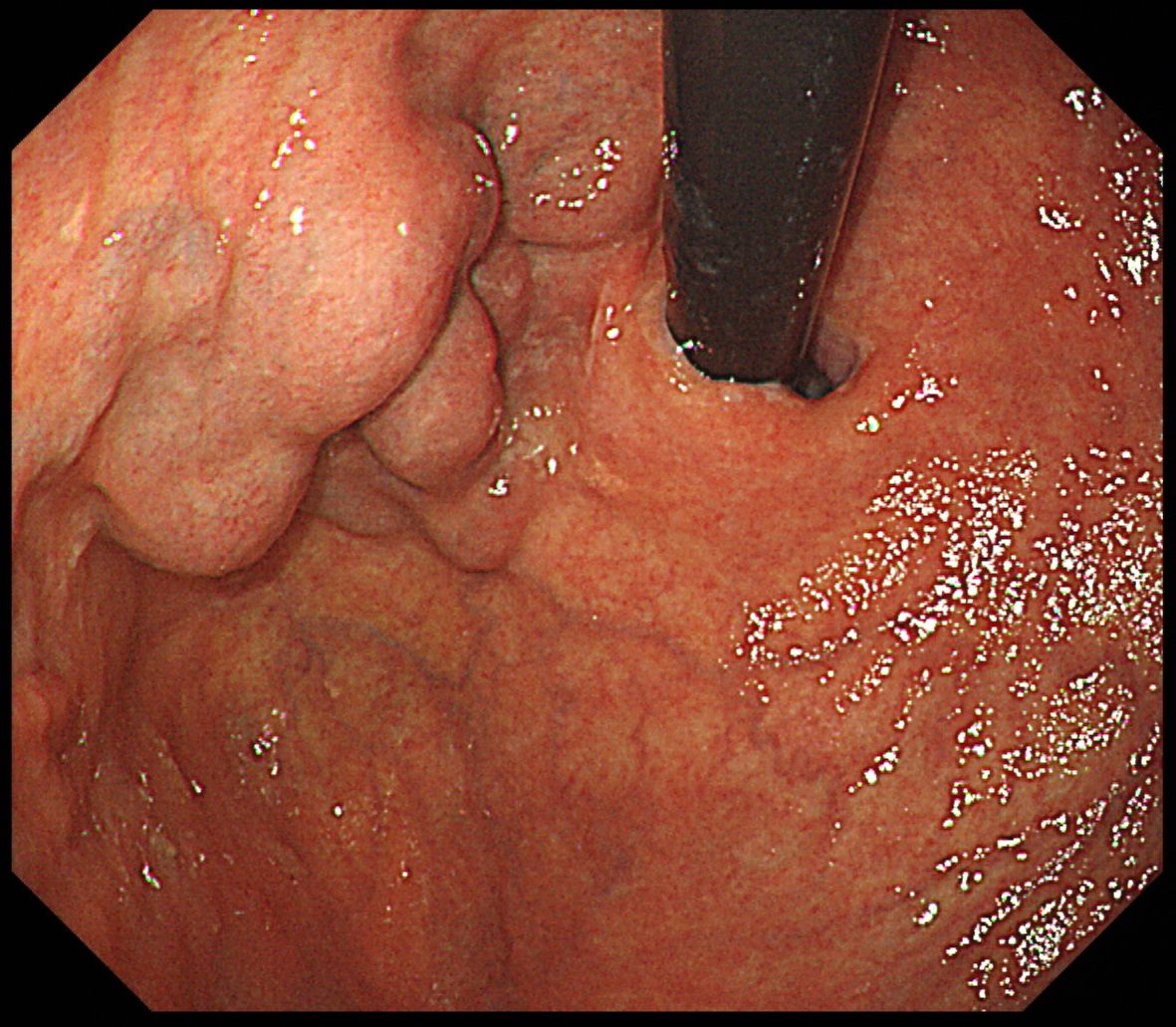 citralgegin i varicoza vene varici în urologie
